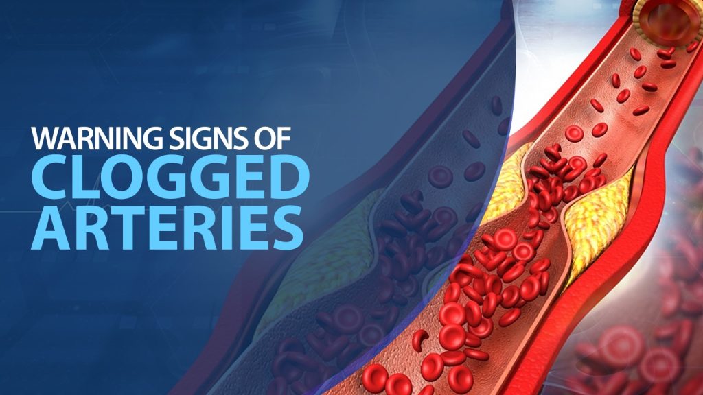 What Are the Warning Signs of Clogged Arteries?