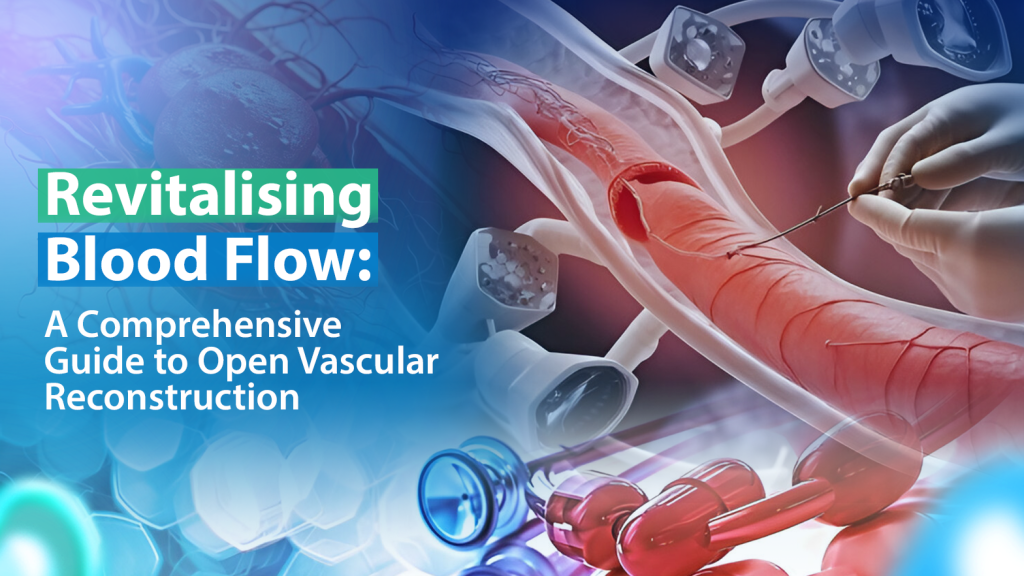 Revitalising Blood Flow: A Comprehensive Guide To Open Vascular Reconstruction